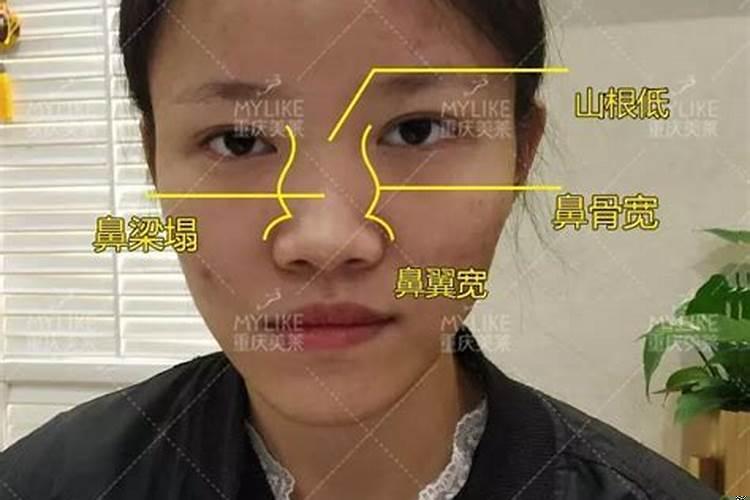女孩子鼻骨凸起来