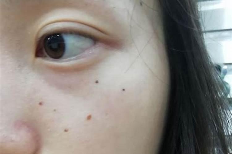 脸上有小痣怎么去掉
