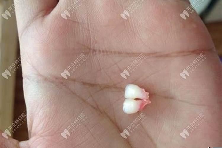 女人梦到牙齿掉了一个