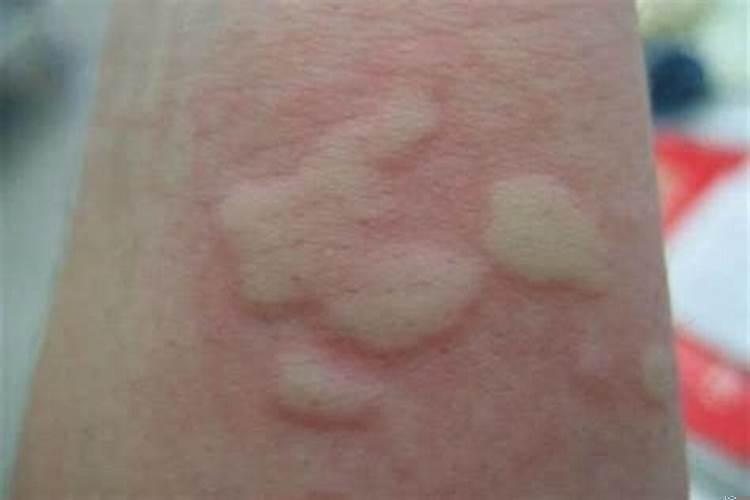 小孩风水疙瘩怎么治好得快